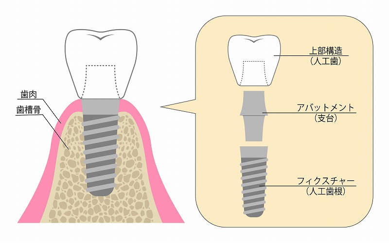 インプラントとは