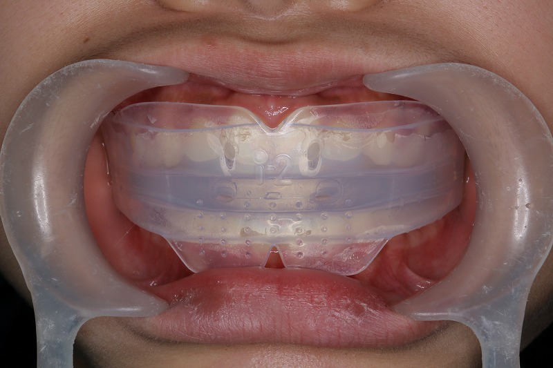 ④トレーナー使用により歯並びの改善とともに口呼吸、舌の突出、間違った嚥下などの口腔習癖を改善します。