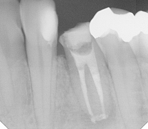 ①術前　下顎小臼歯の根尖病変　未処置根管有