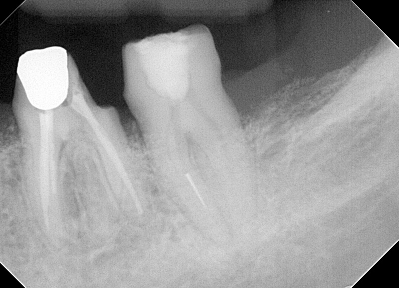 ①術前　下顎大臼歯近心根破折ファイル有