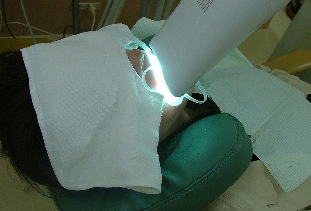 オフィスホワイトニング（ビヨンドシステム）