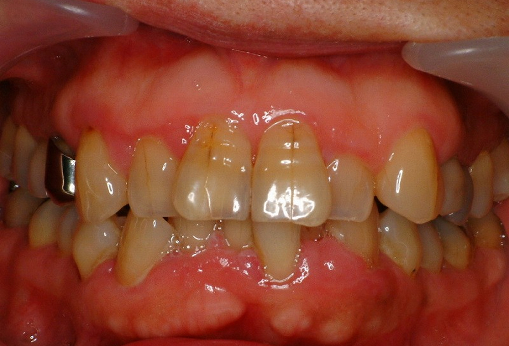 ①ビヨンドホワイトニング術前