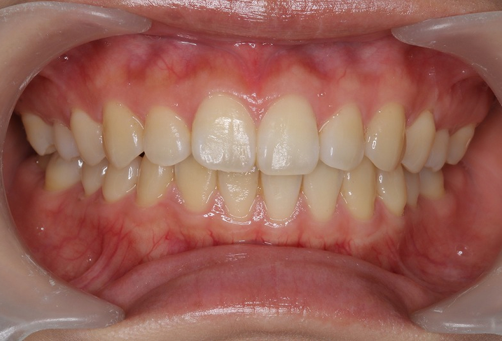 ①ホームホワイトニング術前