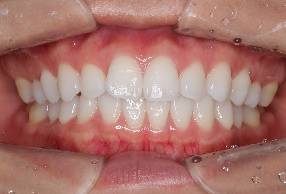 ②ホームホワイトニング術後