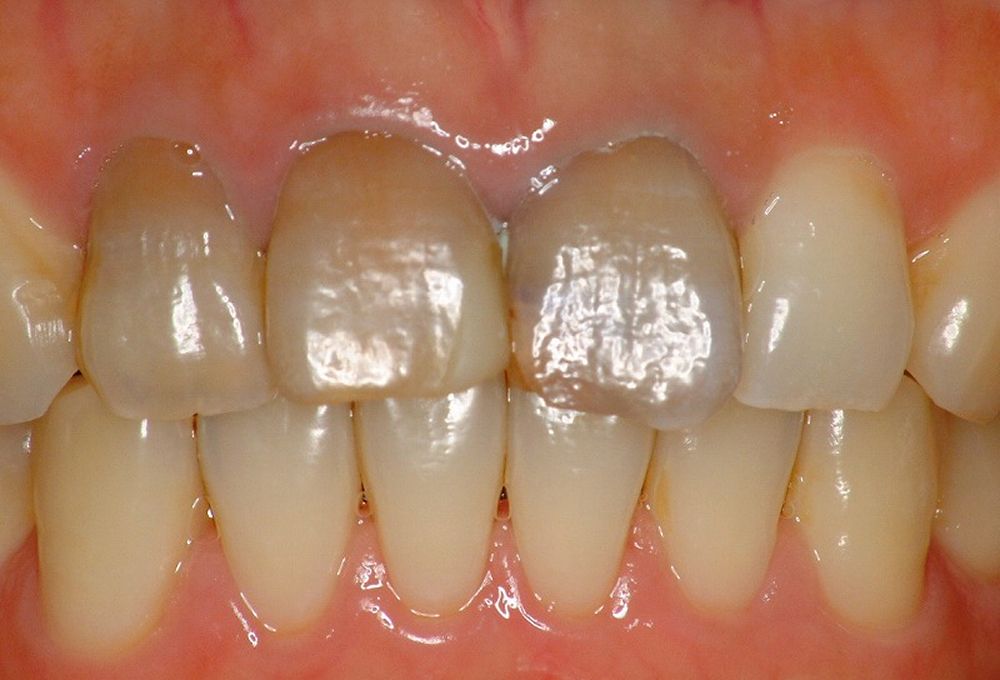 ①ウォーキングブリーチ術前