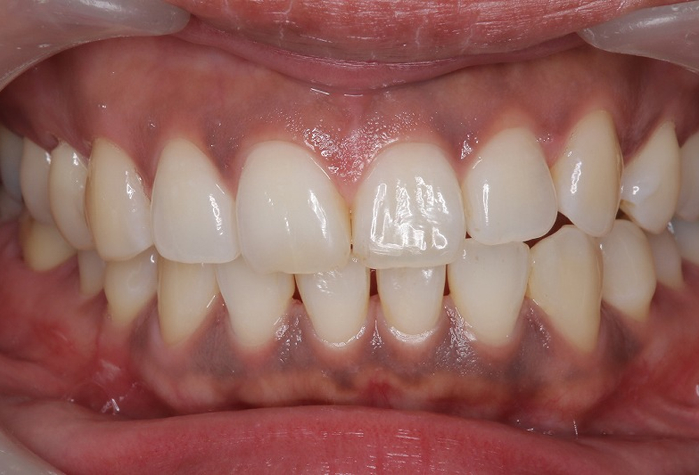 ①歯肉のメラニン沈着術前　スモーカーは要注意です