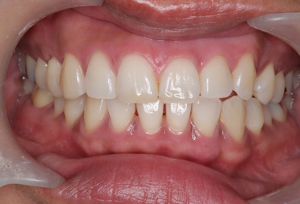 ②施術後　ピンク色の健康的な歯肉に回復