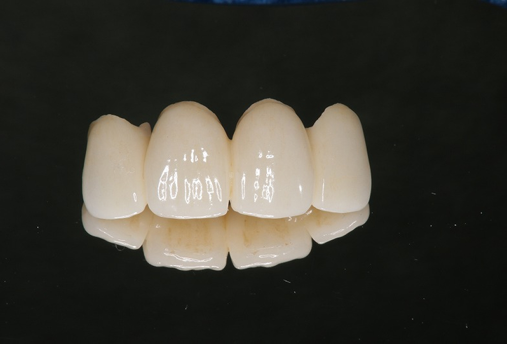 ②オールセラミック作製