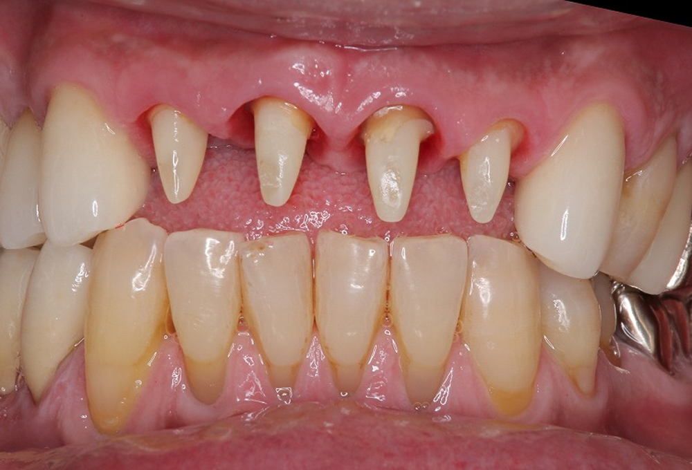 ③装着前の支台歯