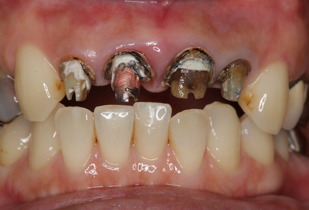 ②クラウン除去後