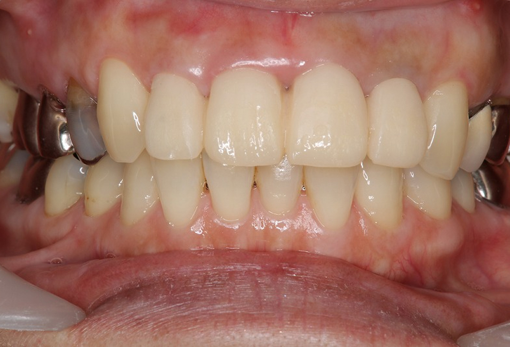 ③仮歯装着