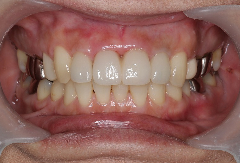 ④術後4前歯オールセラミック