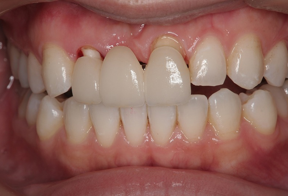 ②オールセラミックブリッジ装着前
