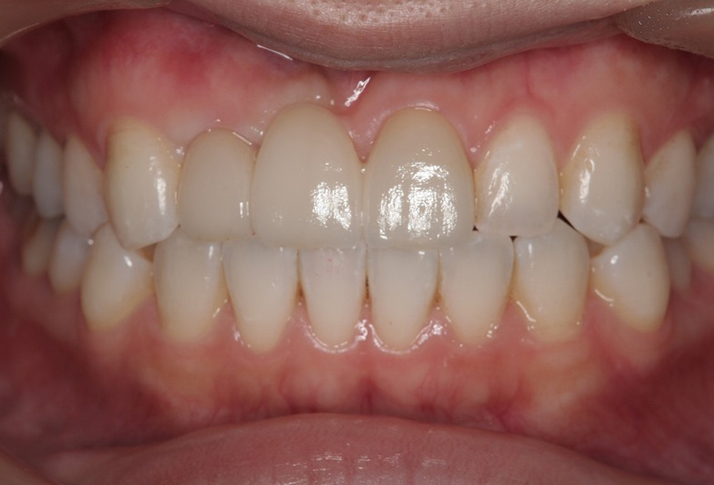 ③術後オールセラミックブリッジ装着