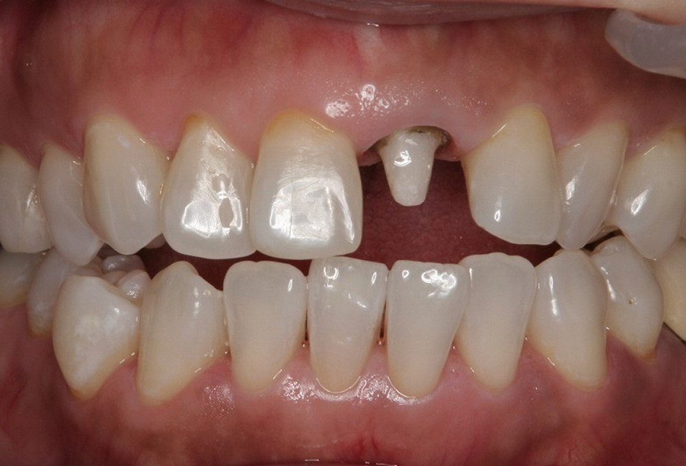 ②ホワイトニング後