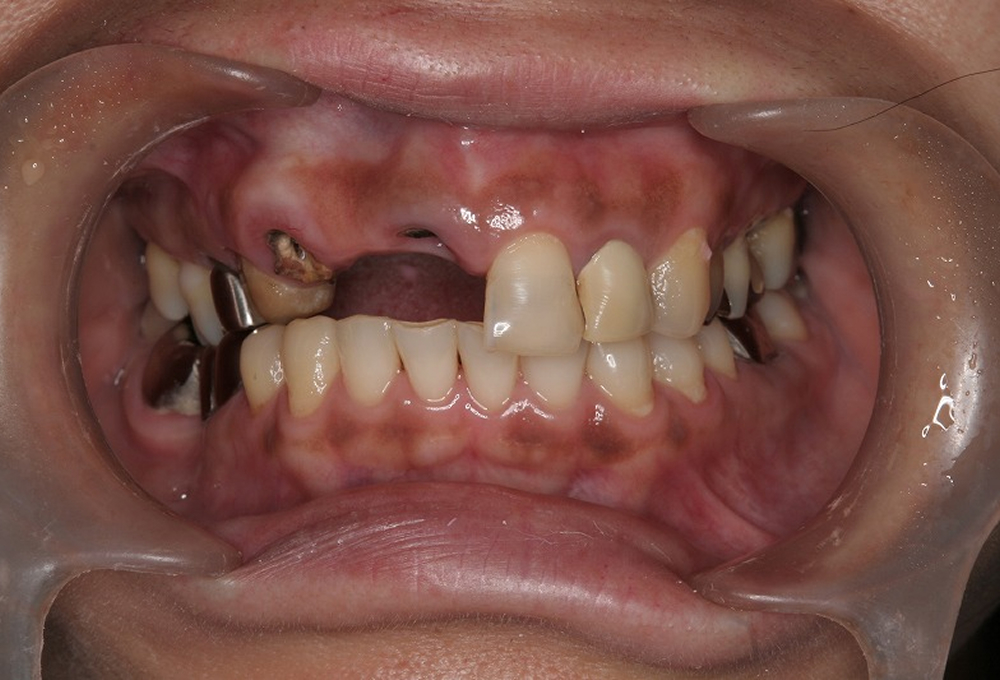 ①術前ブリッジ脱離