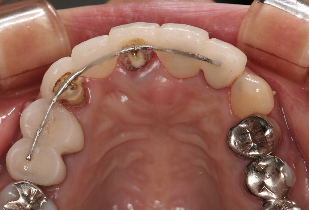③エクストルージョン　歯牙牽引