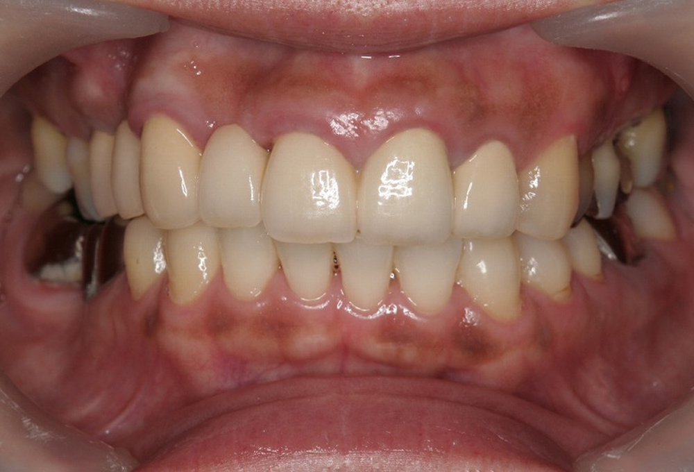 ④術後　メタルセラミックにて治療