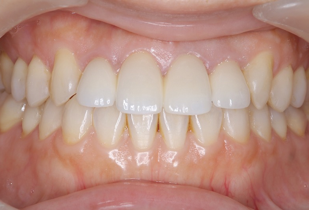 ③術後、ホワイトニング後、オールセラミック装着