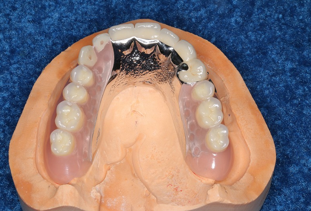 ③ノンクラスプ金属床、オールセラミック作製