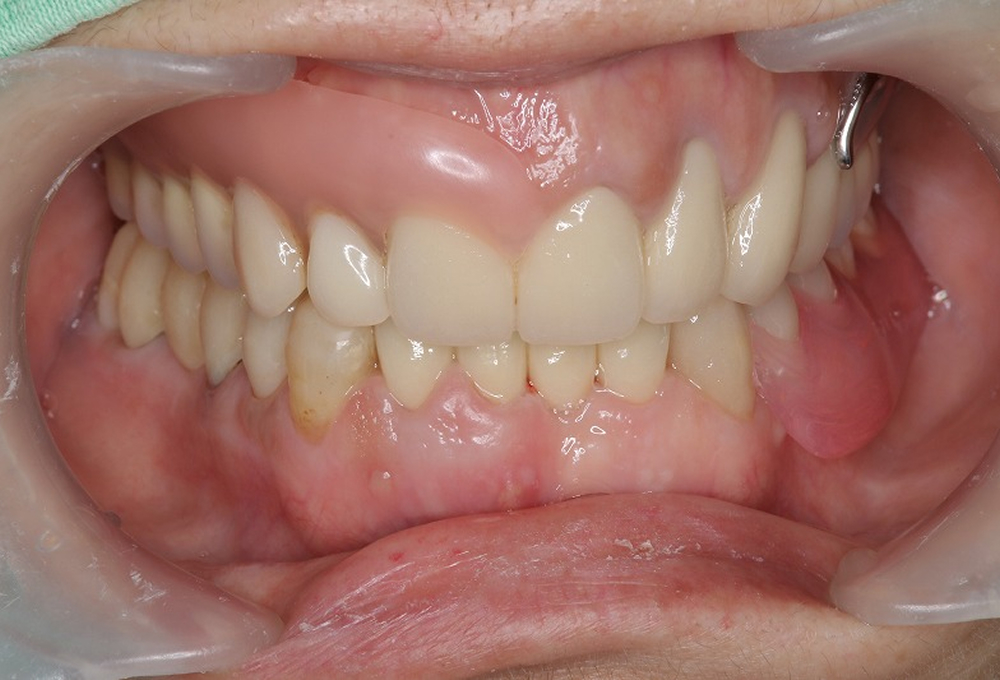 ④術後　咬合挙上後ﾉﾝｸﾗｽﾌﾟ金属床と前歯オールセラミック装着