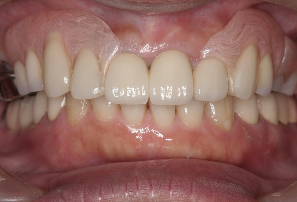 ③術後　ノンクラスプ金属床装着