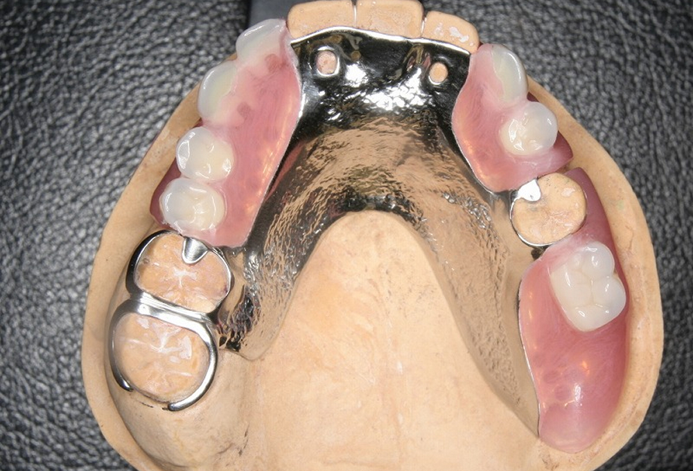 ②不良補綴物治療後ノンクラスプ金属床作成