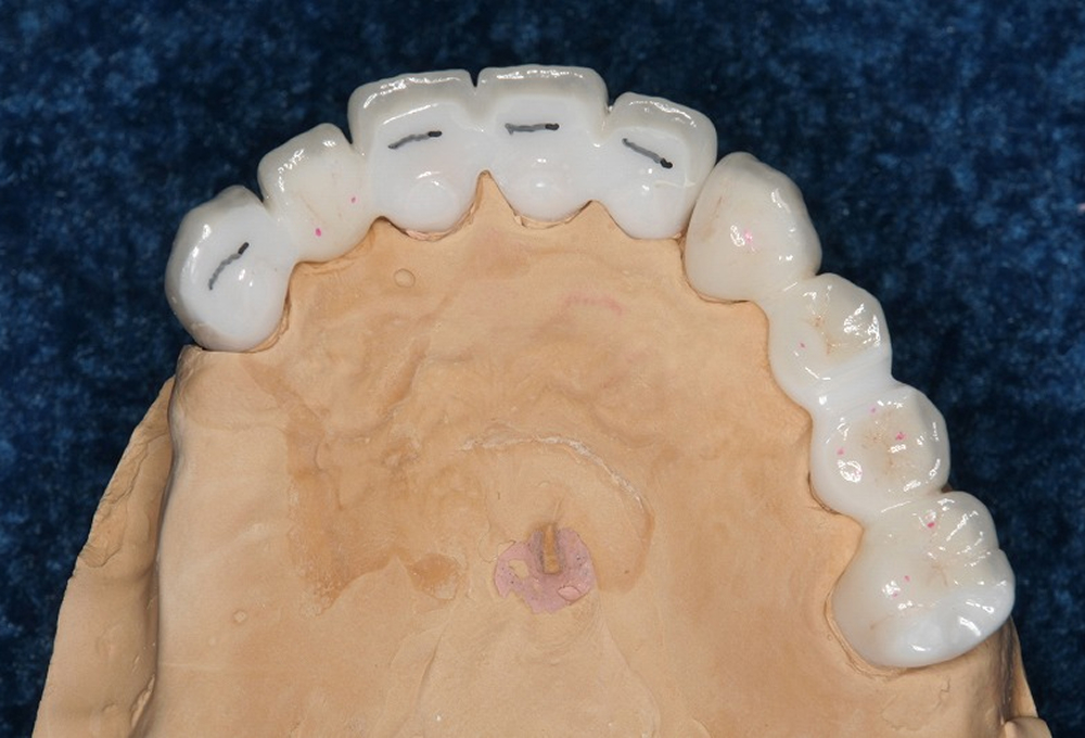 ③オールセラミック作製