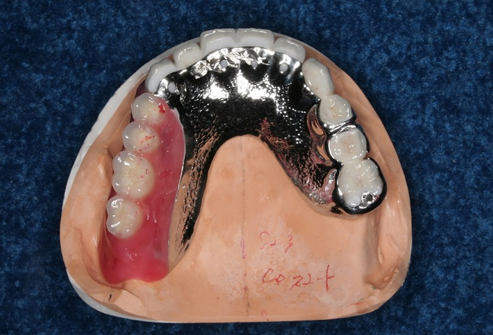 ④ノンクラスプ金属床作製