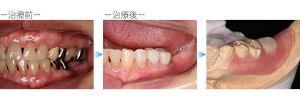 スマイルデンチャー