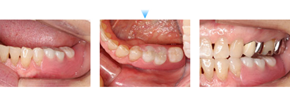 スマイルデンチャー