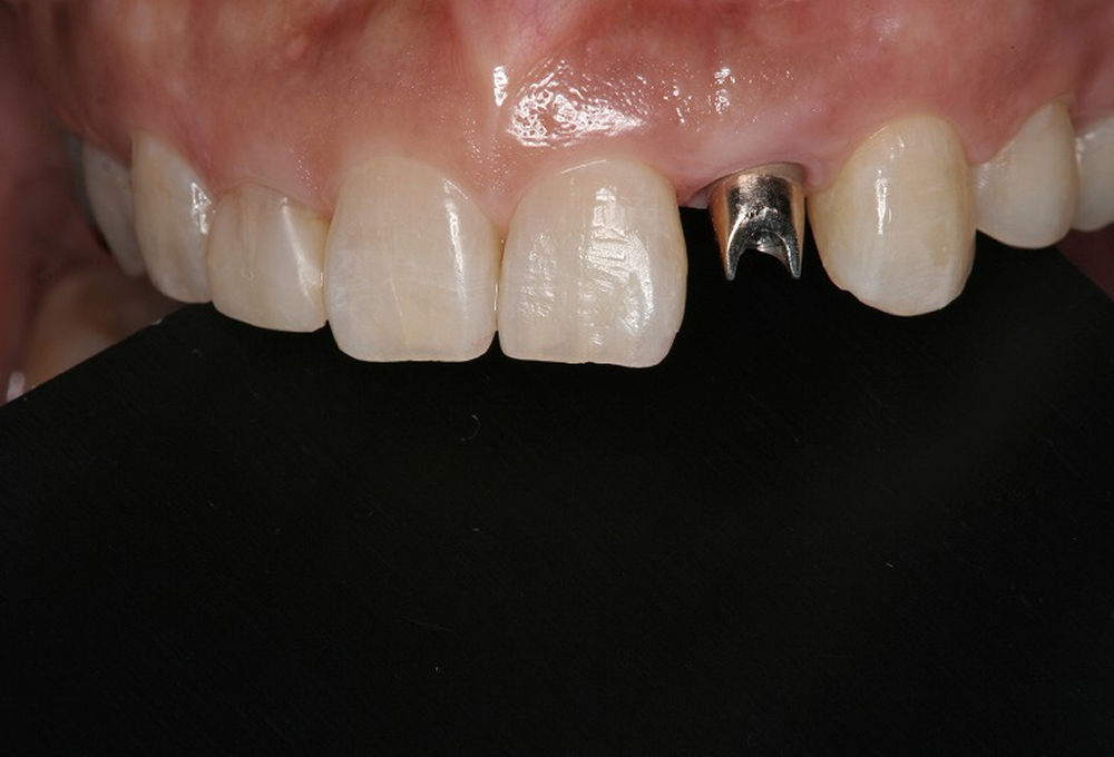 ⑦アバットメント装着後