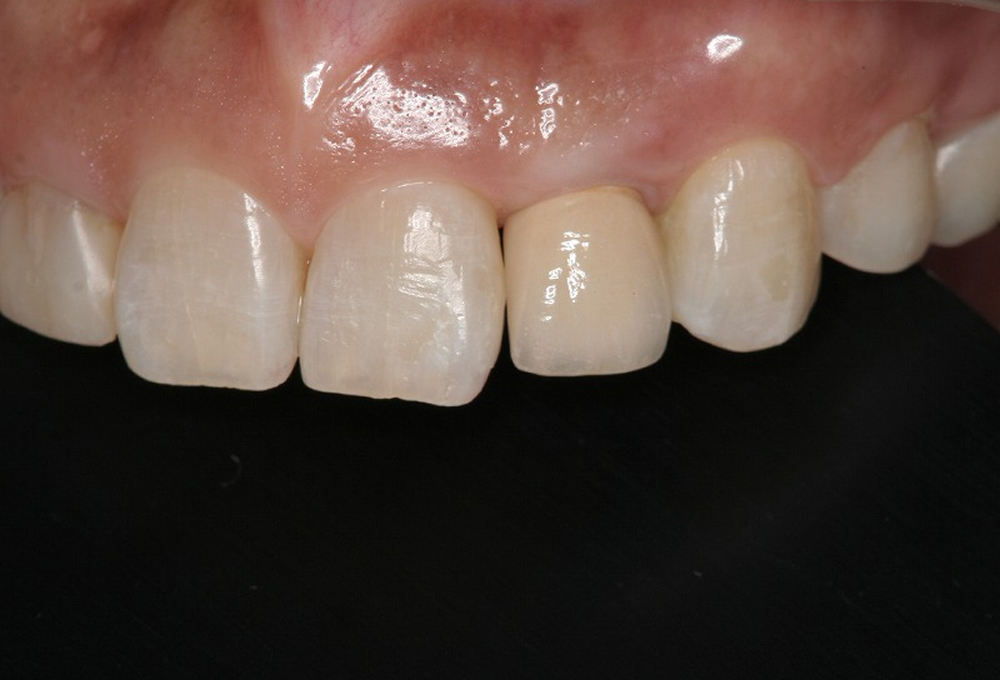 ⑧メタルセラミック装着