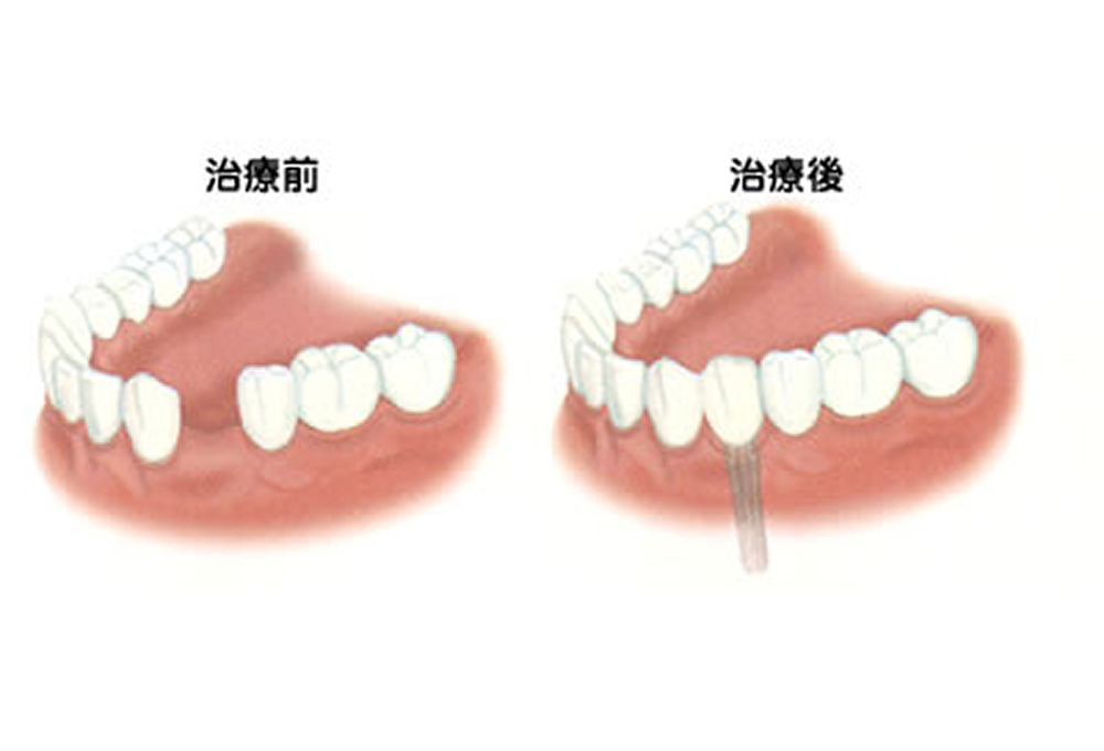 インプラントの治療例