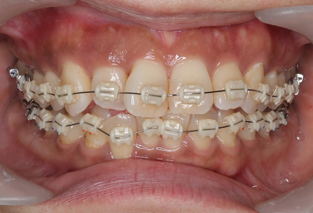 ②マルチブラケットにて矯正