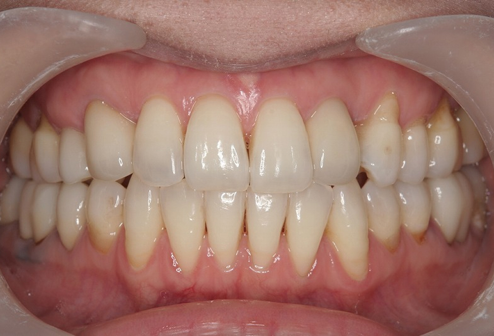 ⑥術後　ホワイトニング後セラミックにて修復