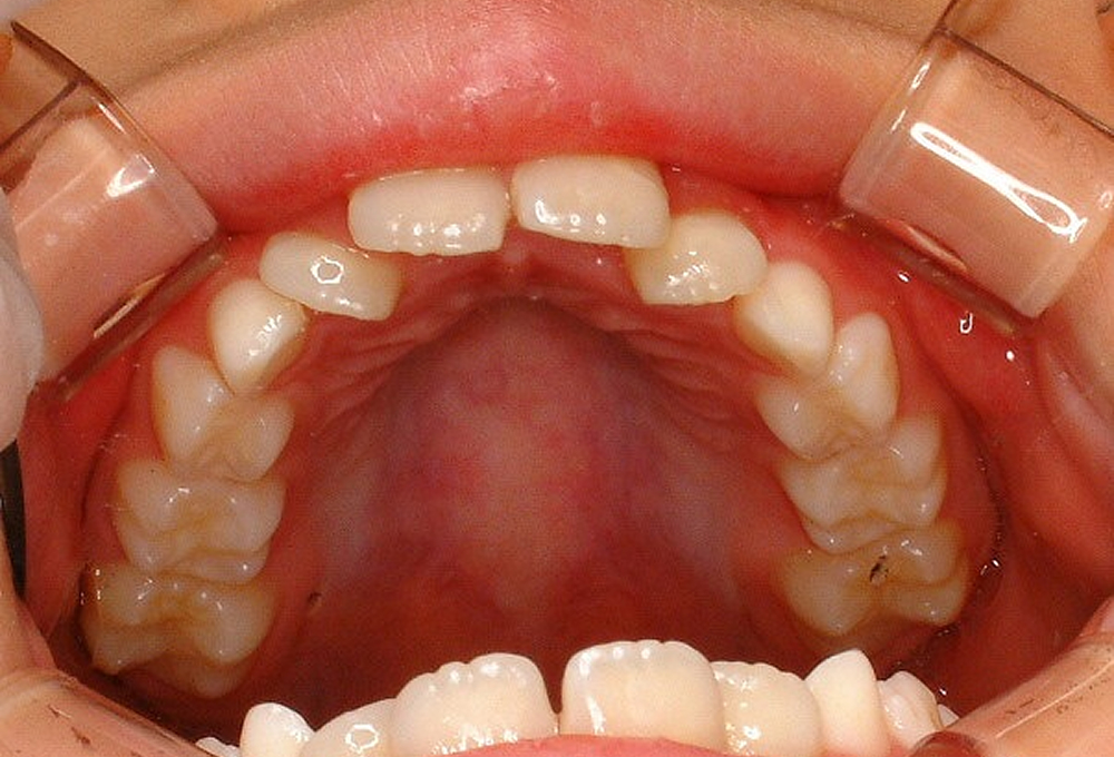 ②術前　上顎　叢生