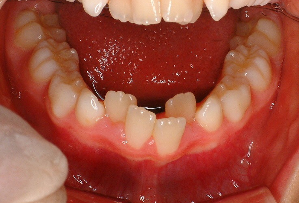 ③術前　下顎　叢生