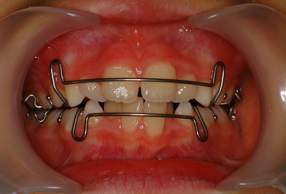 ④上下顎　拡大床装着