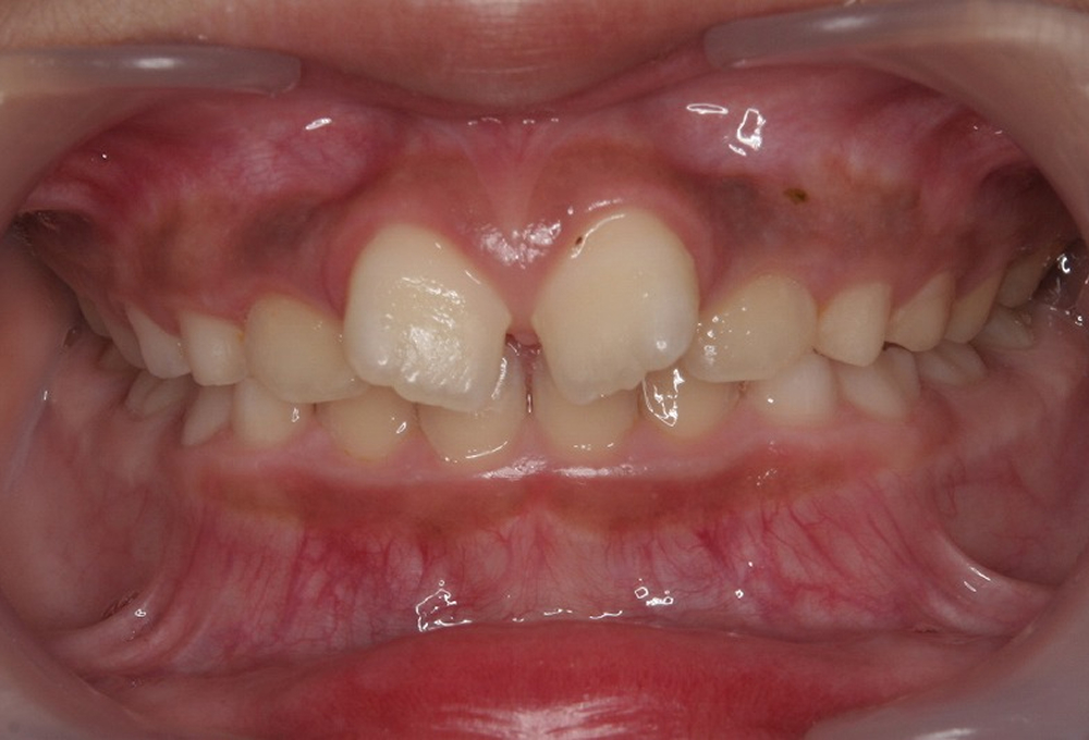 ①術前　前歯部翼状捻転