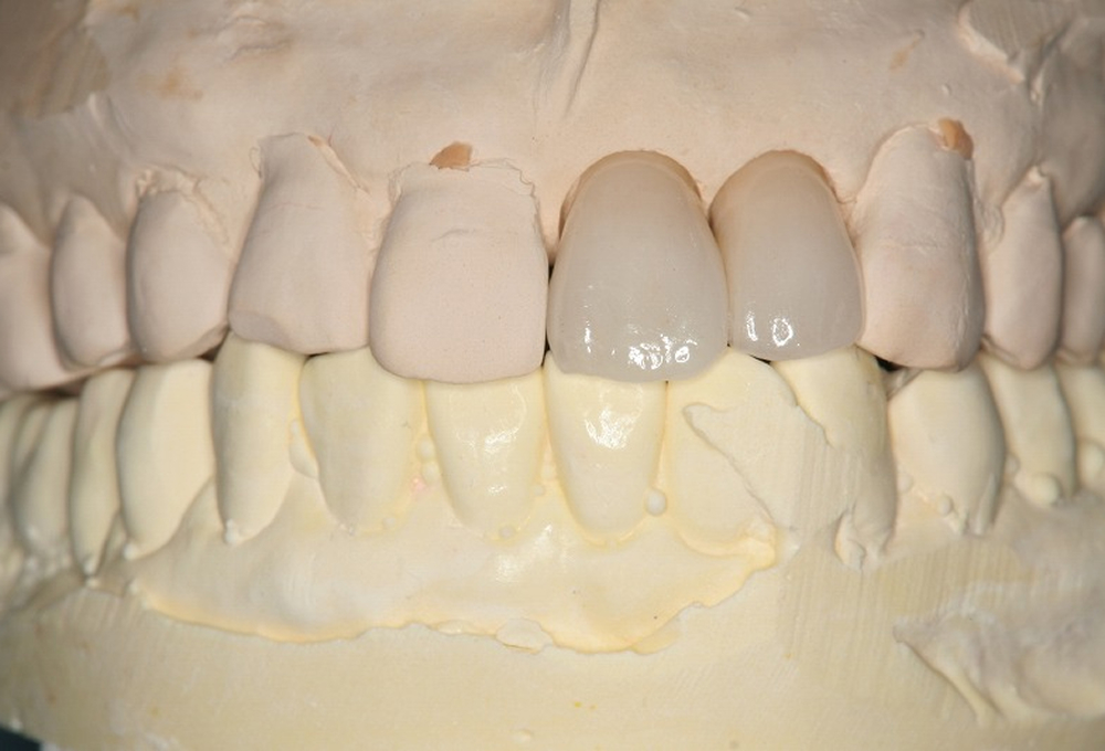 ③オールセラミック