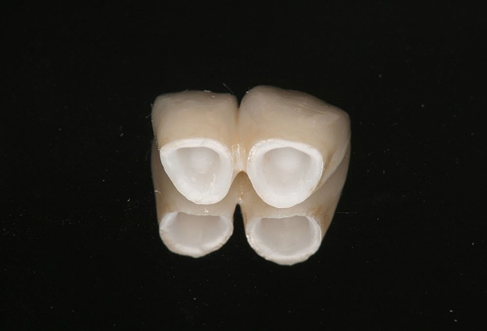 ④オールセラミック