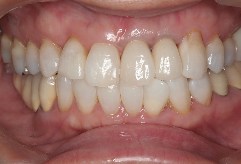 ⑤ホワイトニング後　オールセラミック作製