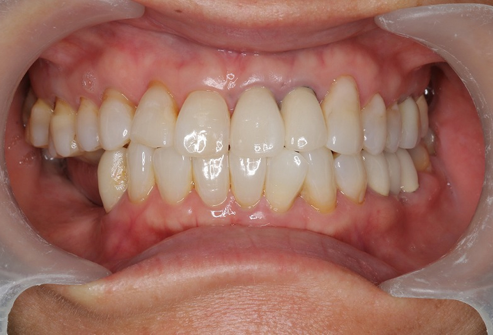 ⑥インプラント術前