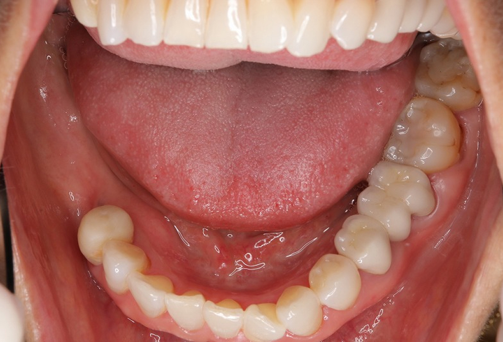 ⑦下顎インプラント術前