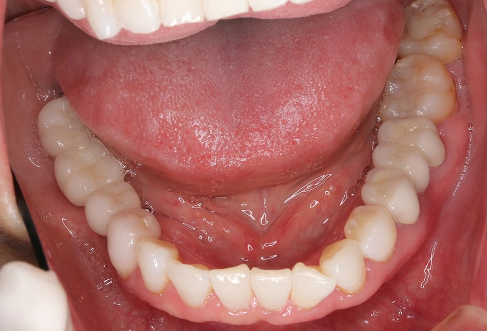 ⑧インプラント術後