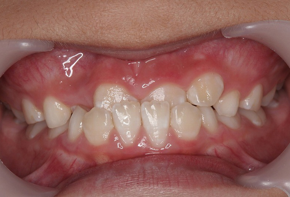 ①術前　反対咬合