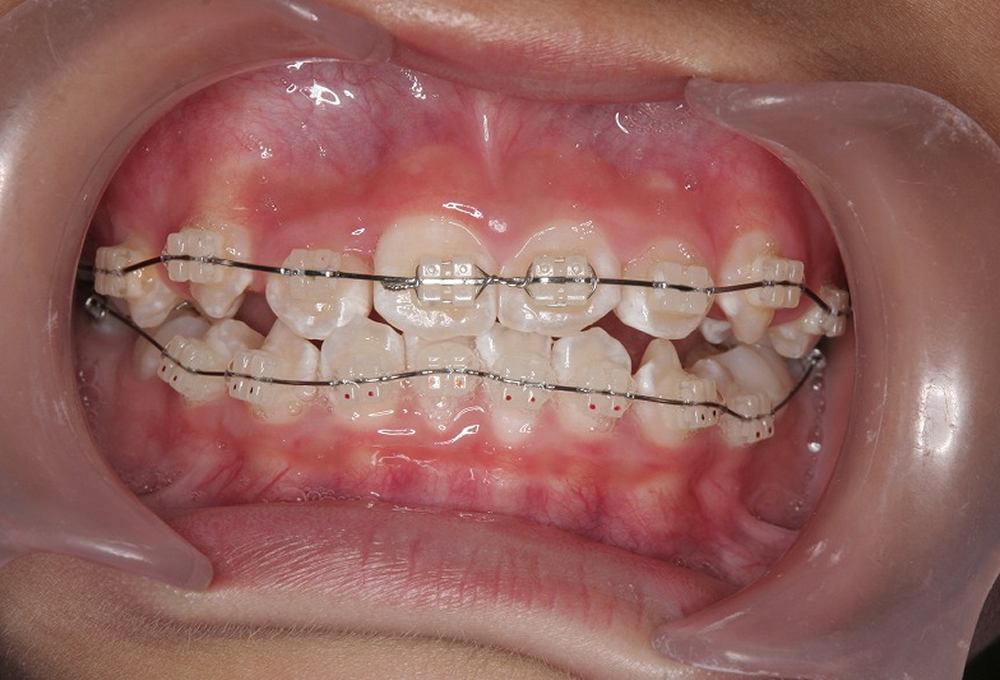 ②マルチブラケットにて矯正中