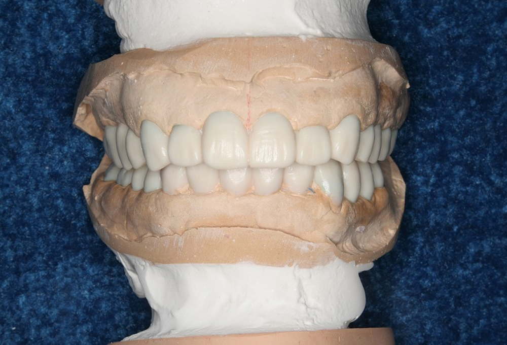 ②診断用ワックス模型