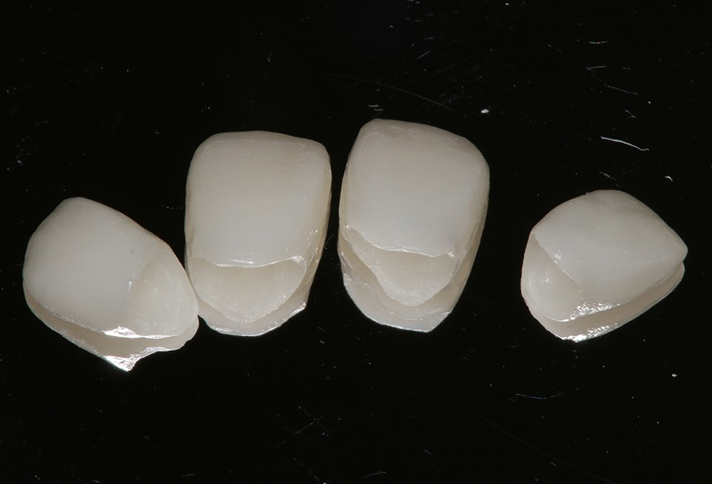 ③オールセラミック装着